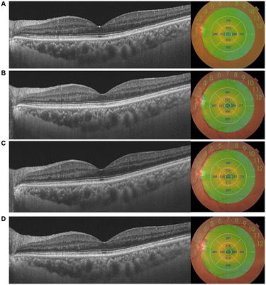 Macular changes following cataract surgery in eyes with early diabetic retinopathy: an OCT and OCT angiography study